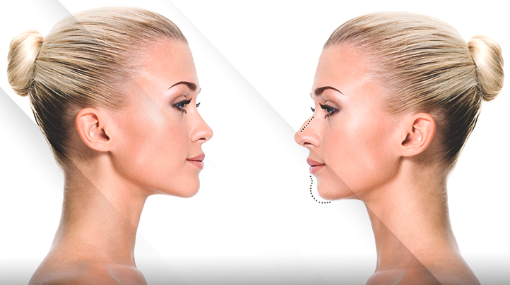 Perfiloplastia: A Harmonização Natural do Perfil Facial com Técnicas Avançadas da Dra. Laura Barros 2 Perfiloplastia