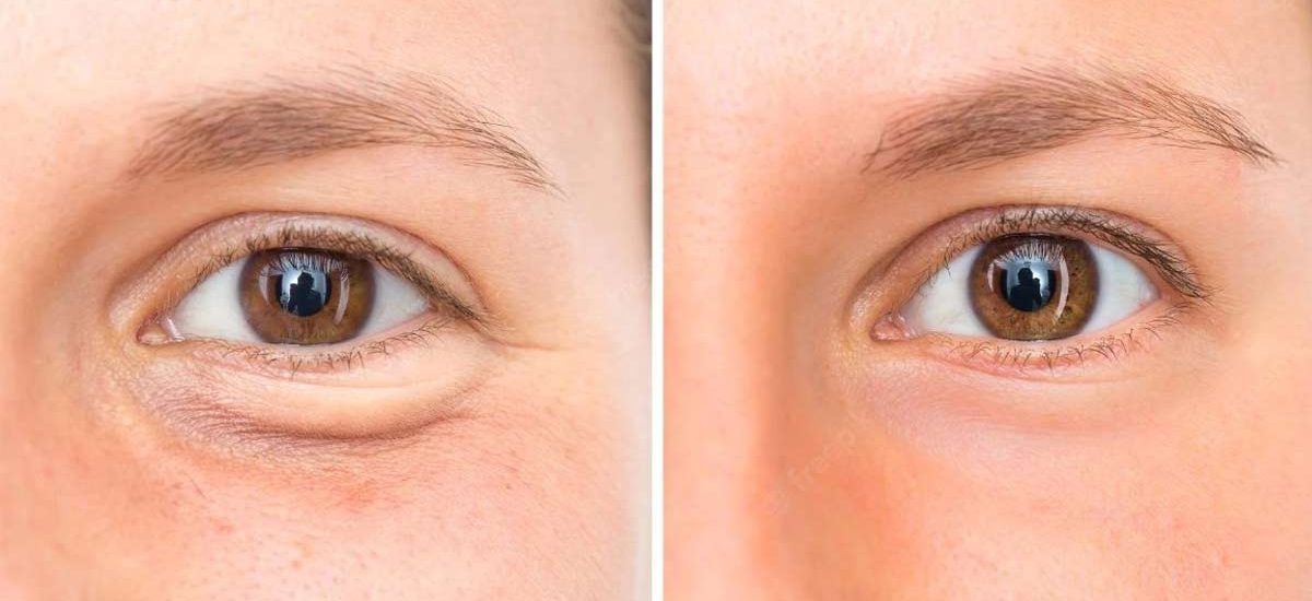 Diferentes tecnicas de blefaroplastia qual escolher