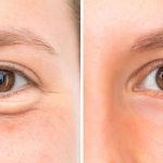 Diferentes tecnicas de blefaroplastia qual escolher