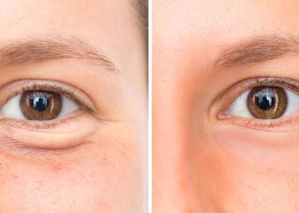 Diferentes tecnicas de blefaroplastia qual escolher