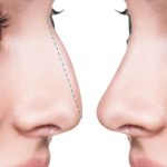 Rinoplastia Estética