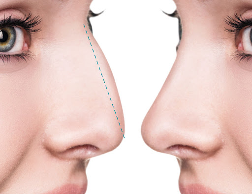 Rinoplastia Estética