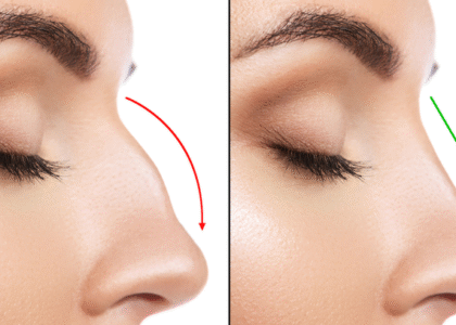 Rinoplastia Estética